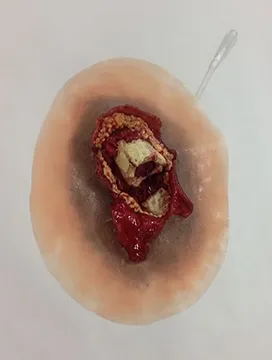 Simulated Bleeding Open Fracture Femur