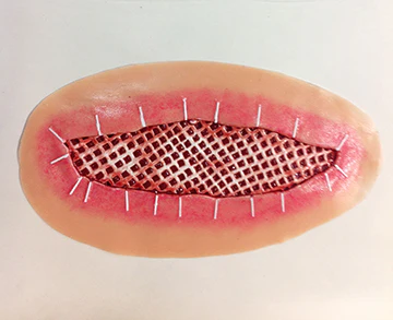 [800-655] Skin Graft (6")