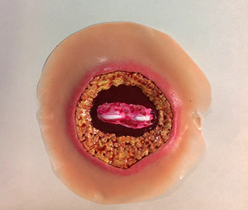 4th Stage Bed Sore (70mm)