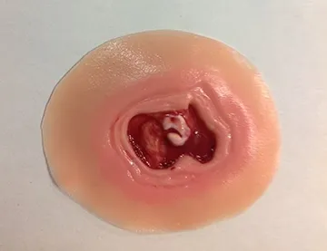 Diabetic Ulcer (20mm)