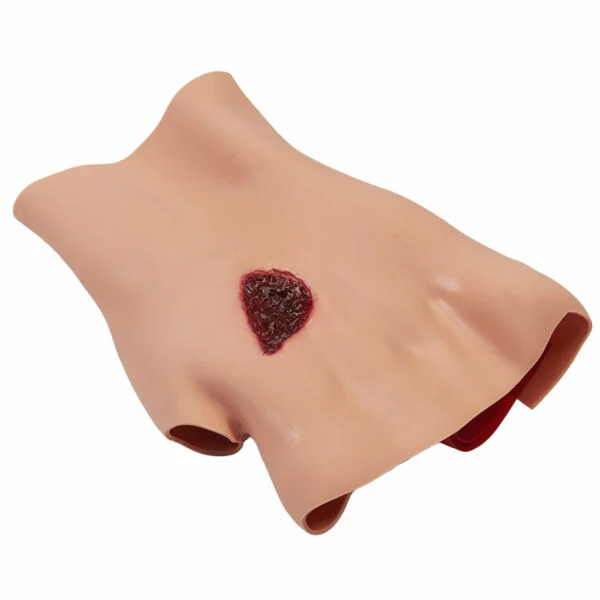 Phosphorous Burn Hand