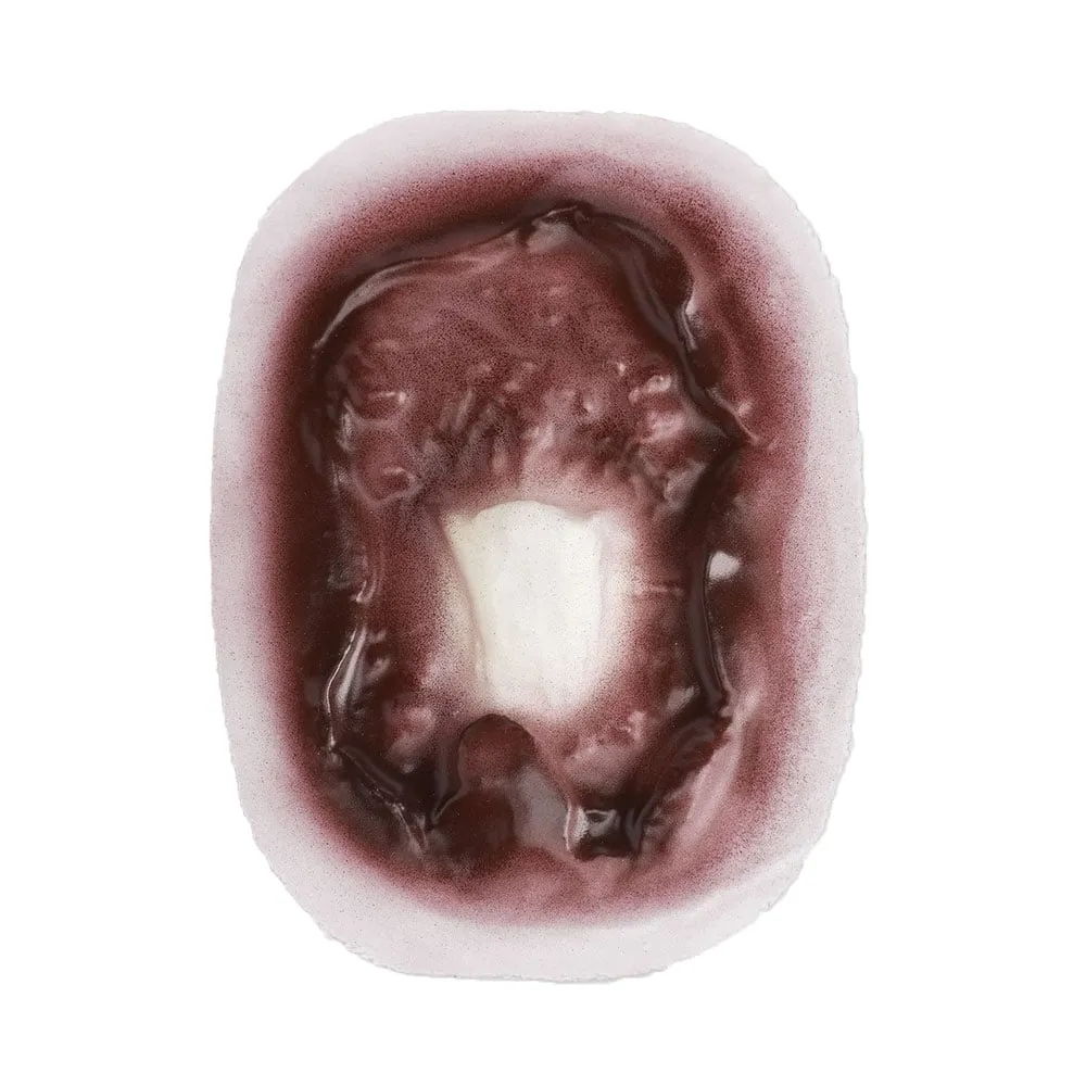 Compound Fracture Humerus (Stick-on)