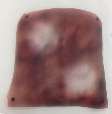 2nd/3rd Degree Chest Burn