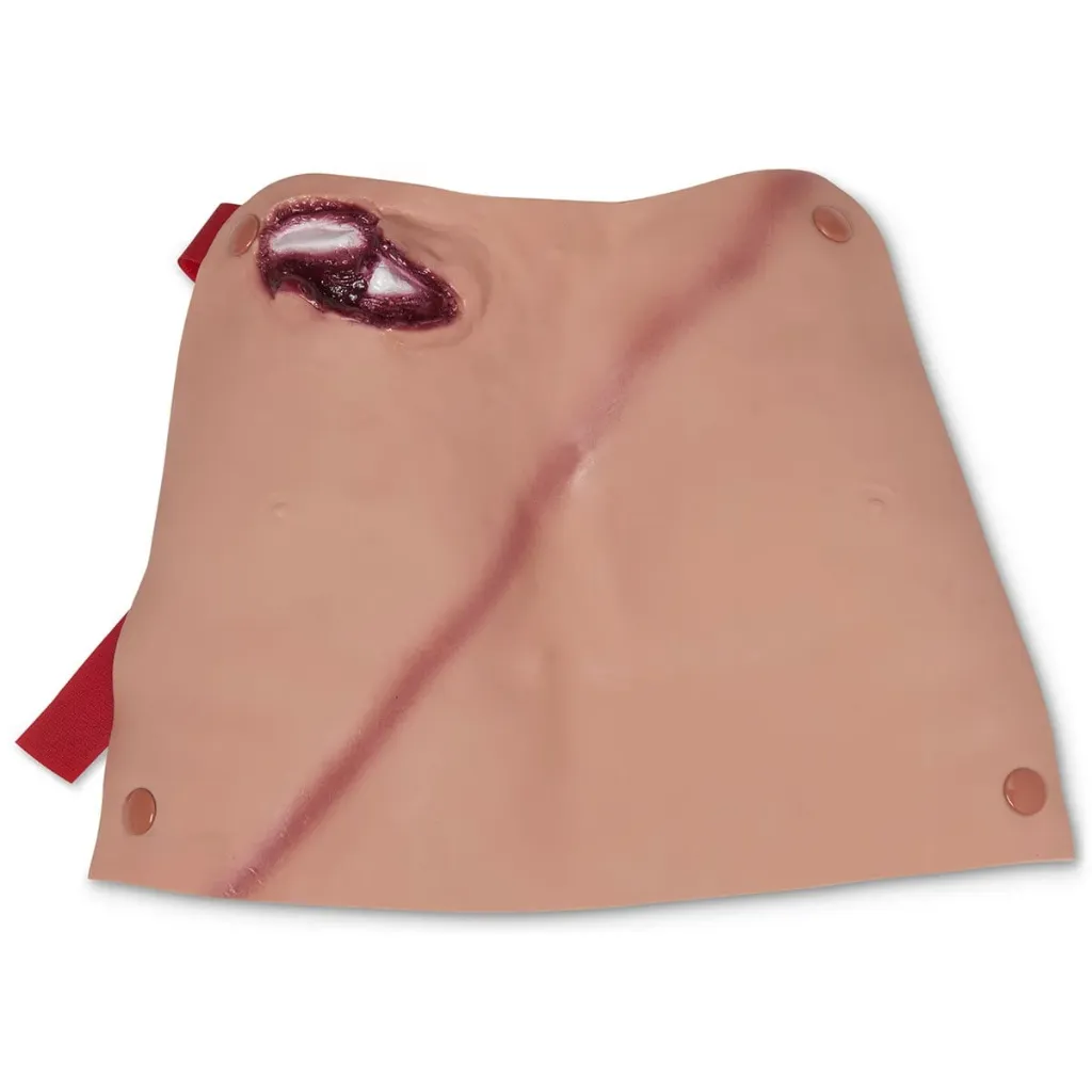 Broken Clavicle (with Contusion)