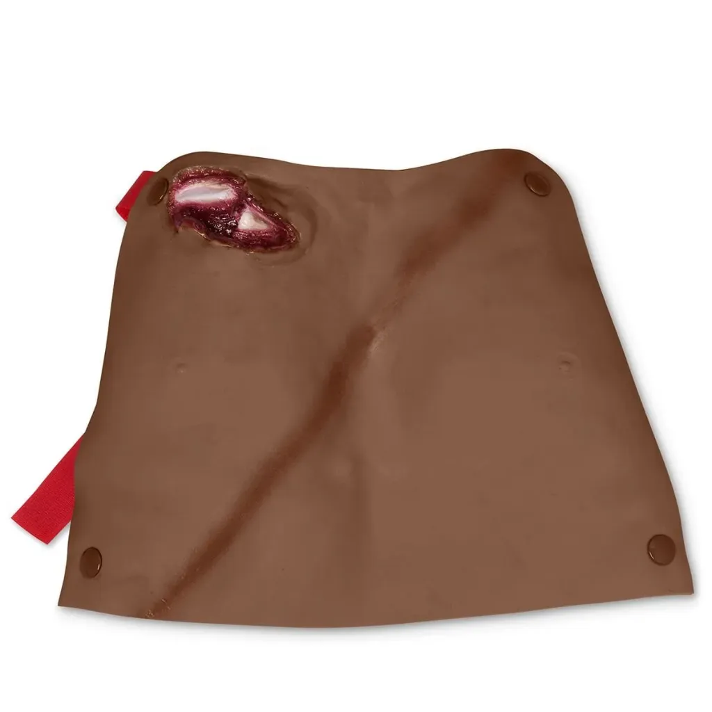 Broken Clavicle (with Contusion)