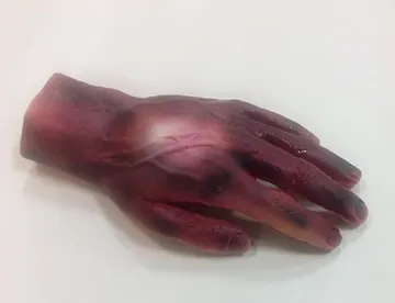 2nd/3rd Degree Hand Burn