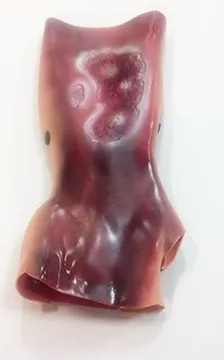 [800-6802] 2nd/3rd Degree Burn Forearm (Light)