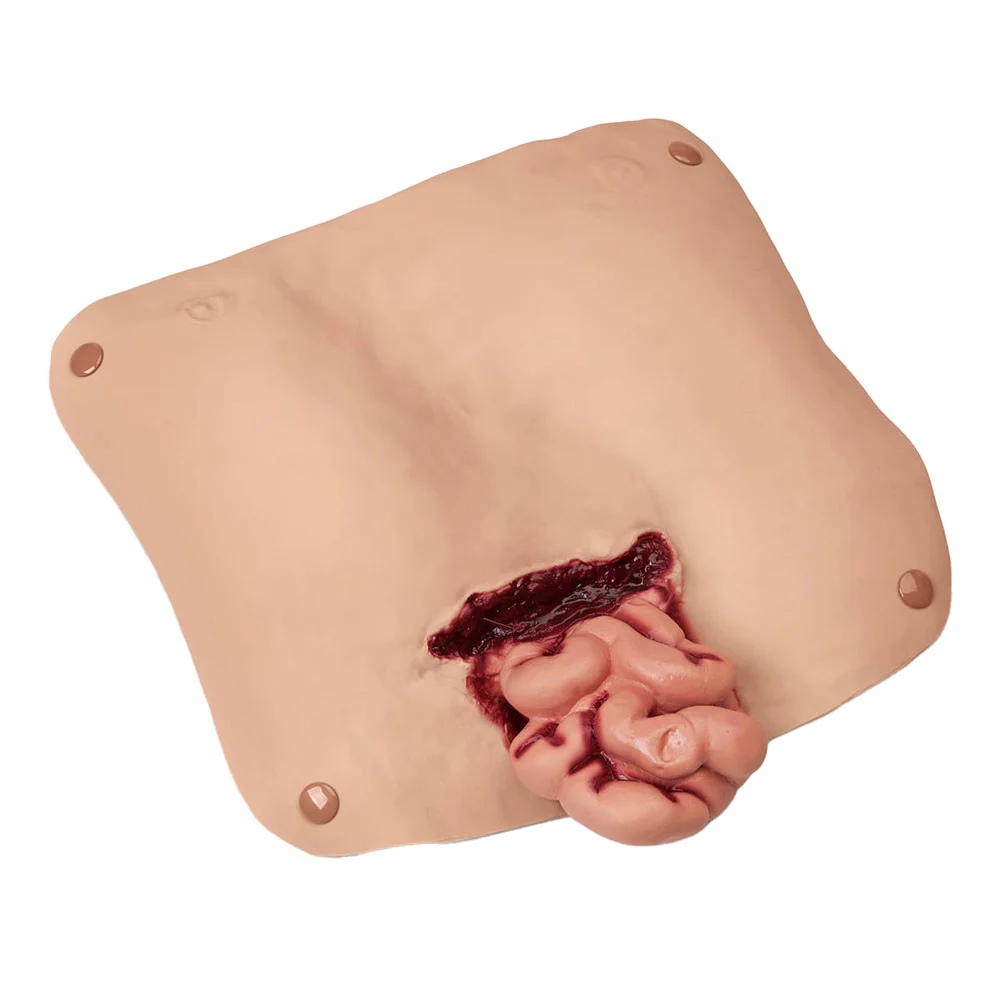 Abdominal Wound (with Protruding Intestines)