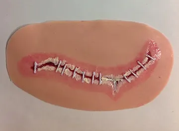 Surgical Site Infection